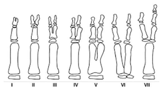Estágios da Polidactilia